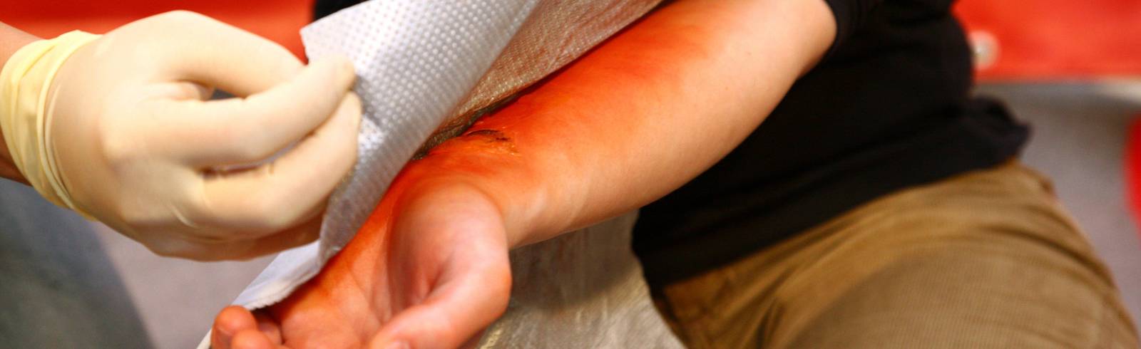 Erste Hilfe bei Grillunfällen