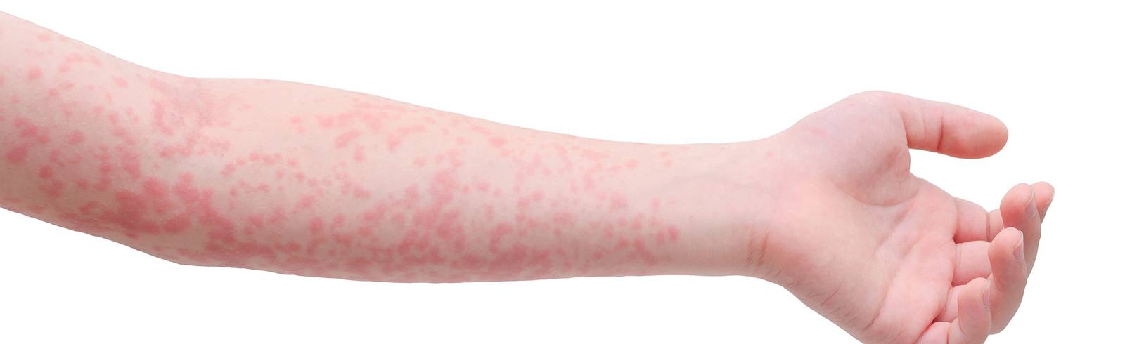 Alarm: Masern breiten sich aus