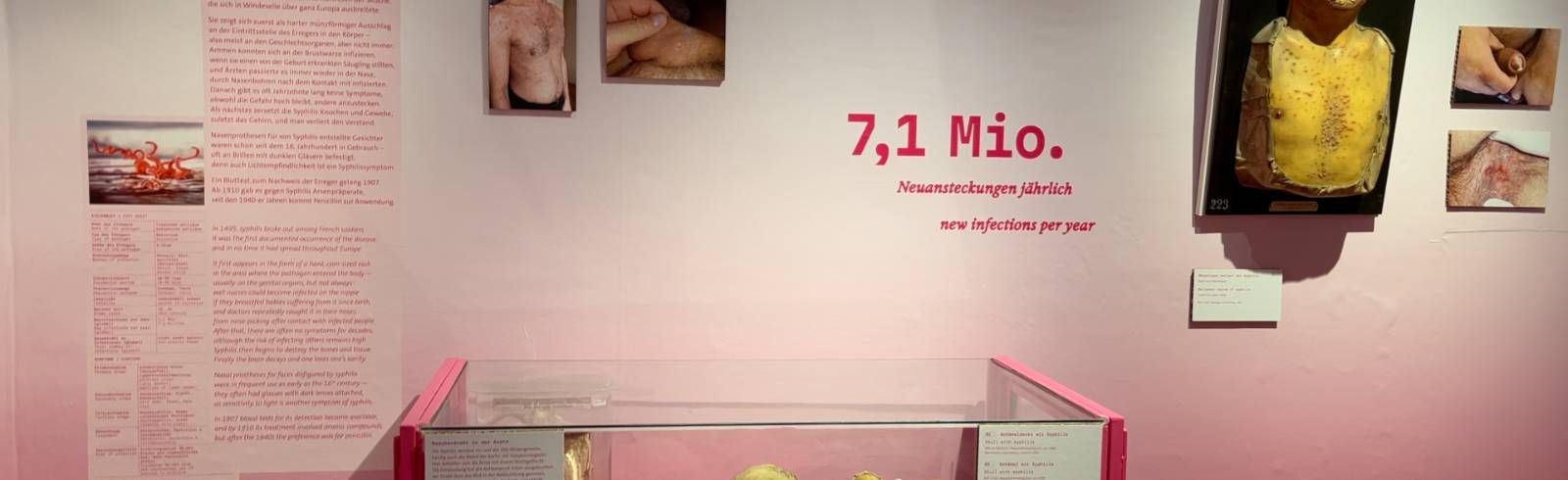 Safe Sex: Neue Ausstellung über Geschlechtskrankheiten