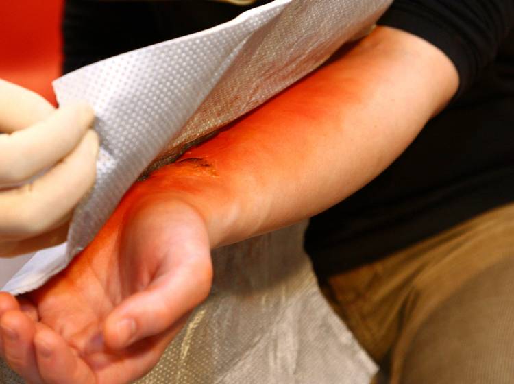 Erste Hilfe bei Grillunfällen