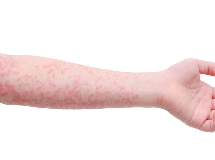 Alarm: Masern breiten sich aus